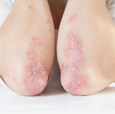 Avaderma Skin & Hair Clinic - Psoriasis